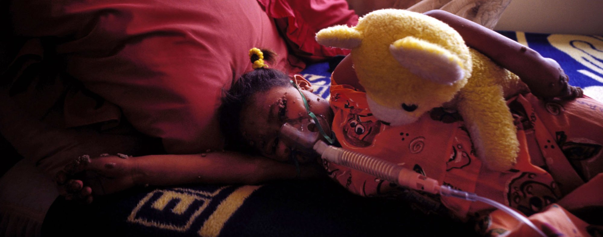 A nine-year-old girl in Johannesburg wears her oxygen mask in her aunt's home. Her mother died of an AIDS-related disease. 